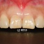 앞니 라미네이트 치료를 통해 치아변색/노화/나비치아 치열을 개선하다. 삼성동 치과
