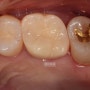 문정역치과) 파절 치아 발치대신 신경치료와 지르코니아 크라운으로 치료한 사례입니다.