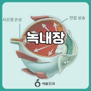 [대전 유성 새봄안과] 녹내장 이란?