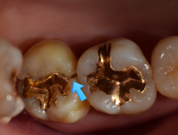 치아가 깨져서 씹기 힘들 정도로 아픈 경우 - 쪼개져서 벌어진 split tooth에 대하여, Q-ray진단 시스템 : 네이버 블로그