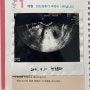 임신극초기증상/쌍각자궁/임신4주/임신6주/임신초기 피비침으로 병원/바우처등록하기