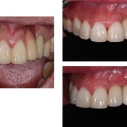 참치과 앞니 임플란트 증례 모음 !