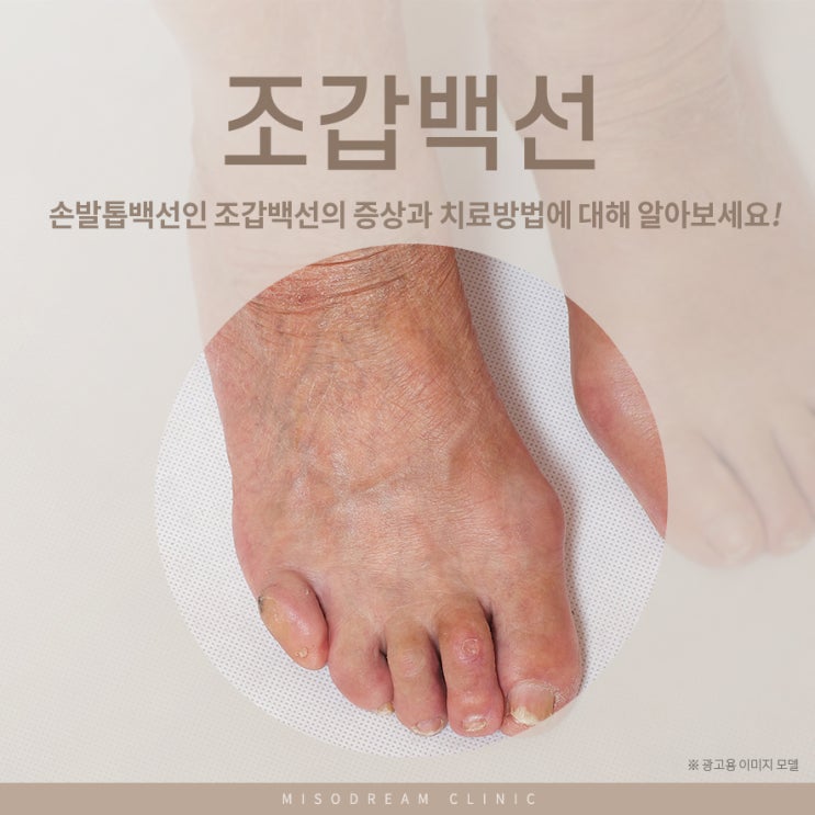 성남피부과 손발톱백선인 조갑백선의 증상과 치료방법에 대해 알아보세요! : 네이버 블로그