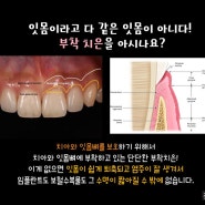 참치과 잇몸이식 증례.