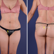 Liposuction and Hip-up surgery for a woman who’s in her 40’s