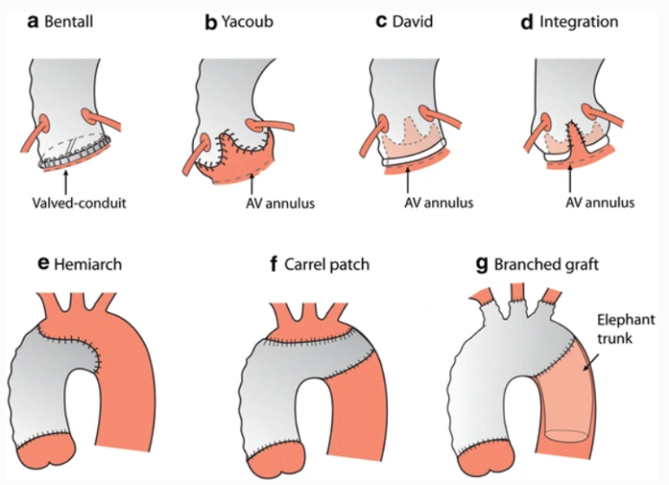Aortic root surgery : 네이버 블로그