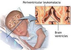 뇌실주위 백질연화증(periventricular leukomalacia ; PVL) : 네이버 블로그