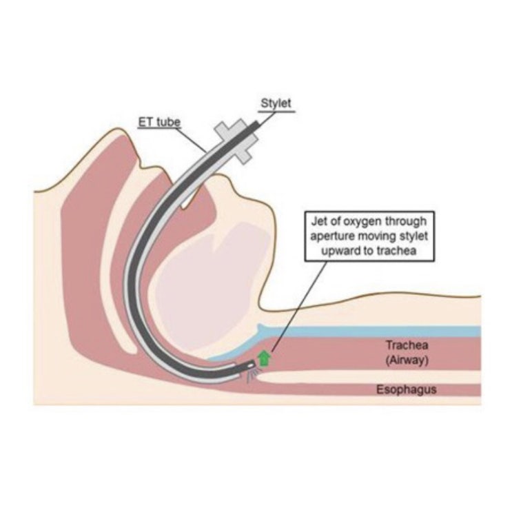 [공부기록] Intubation Box 물품 정리 : 네이버 블로그