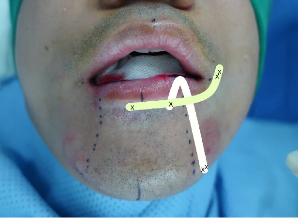 하구순의 Cayler's syndrome- Bidirectional fascia lata sling operation : 네이버 블로그