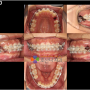 치과의사 스스로 교정을 겪다. 14편 교정 중 자꾸 사진을 찍는 이유?
