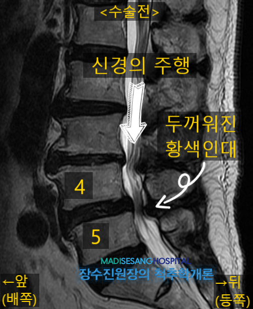 허리(요추) 협착증 수술(감압술)을 자세히 들여다봅니다. : 네이버 블로그