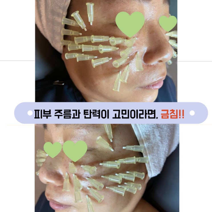 금침으로 팔자주름, 얼굴 주름, 피부를 젊고 탄력있게! : 네이버 블로그