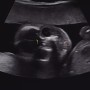 [20주 6일] 임신 6개월 / 정밀초음파 / 정밀초음파 비용 / 태동 / 임산부 충치치료 / 임산부 독감주사 / 성별반전