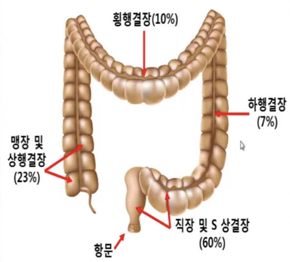 구불결장의 악성신생물(C18.7), 제자리암, 상피내암(D01.0), 대장점막내암(D01), 대장암(C20) 암진단금, 수술금 ...