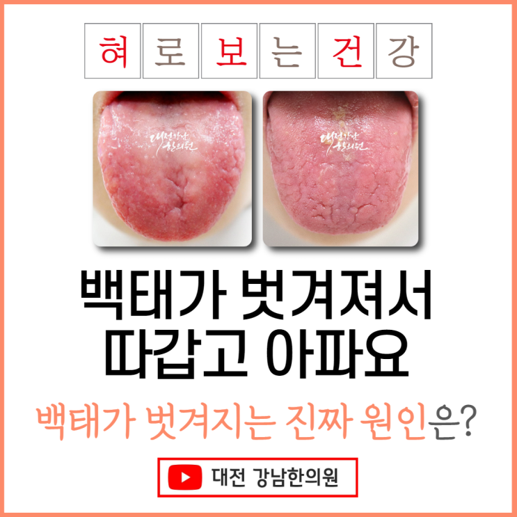 지도설/위축성설염: 백태가 벗겨져서 혀가 따갑고 아파요 : 네이버 블로그