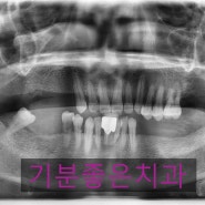 [부천치과/상동역치과/임플란트/부천임플란트/상동치과/치과치료] 이제는 치료를 하고 싶어요