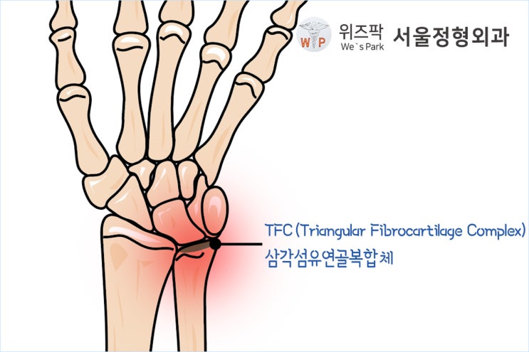손목 통증을 유발하는 TFC 삼각섬유연골복합체 손상이란? : 네이버 블로그