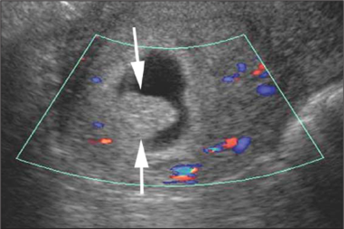 Chorionic Bump : 네이버 블로그