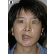 양악수술과 안면신경마비(양악수술후 구안와사?)