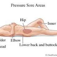 [간호입문 : 욕창(Sore, Pressure Ulcer)2-2]욕창(Sore, Pressure Ulcer)의 호발부위, 욕창 간호