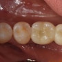 군산 치과/임플란트 치료기간 안아프게 줄일 수 있는 수술방법은?