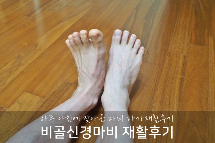 비골신경마비 증상 및 자가 재활운동 후기 : 네이버 블로그