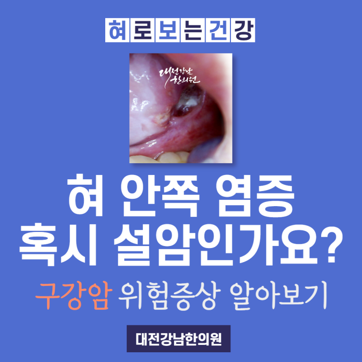 혀 밑에 뭐가 생겼는데 혹시 설암인가요? 구강암 초기증상 알아보기 : 네이버 블로그