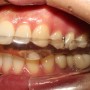치과의 이갈이 치료법-장치&주사