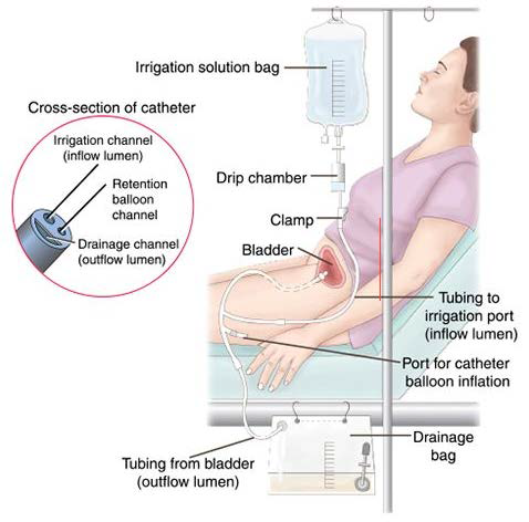 Continuous Bladder Irrigation (CBI) : 네이버 블로그