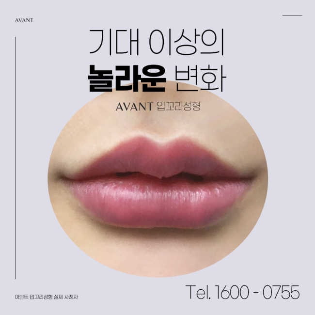 입꼬리성형! 자신감 있는 입매무새로 ! 아반트성형외과 !! : 네이버 블로그