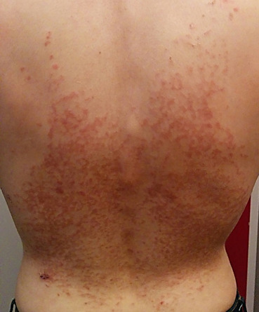 [색소성 양진] 다이어트 두드러기, keto rash : 네이버 블로그