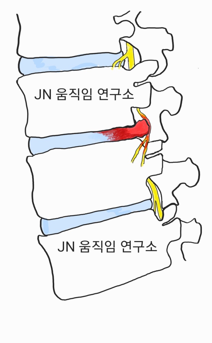 허리 통증의 원인 추간판 탈출증!! 똑똑하게 알고, 똑똑하게 예방하자!! : 네이버 블로그