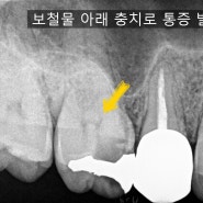 보철물 하방 충치 신경치료 케이스