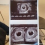 임신초기 6주차증상 초음파 아기집 크기