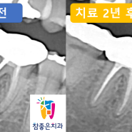 이가 아파요... 금속 포스트가 있는 치아의 재신경치료 이야기 - 동이 있는 근단주위농양, 금속 포스트, 재근관치료, 재신경치료, 골드 크라운