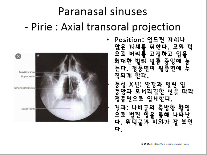 [일반촬영] 코곁동굴 Pirie법 : 구강을 통한 축방향 촬영 (Paranasal sinuses - Pirie : Axial ...