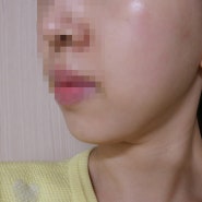 엑셀브이 레이저, 트루스컬프 처음 받아본 솔직후기 : 색소레이저 / 리프팅후기