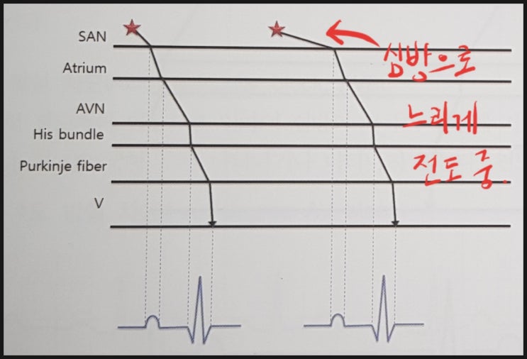 동방 차단 (SinoAtrial block ; SA block) : 네이버 블로그