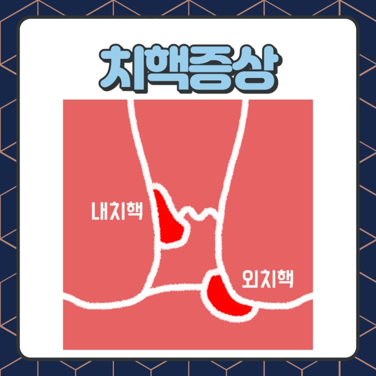 치핵 증상 자연치료, 내치핵 외치핵 끝낸 비법 : 네이버 블로그