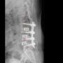 남양주 디스크 협착증 치료-허리 척추 유합술 후 통증 재발