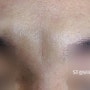 [선정릉역피부과] 미간 주름 필러/보톡스 차이와 효과 및 한계점, 실제 전후 증례 - ST성모피부과