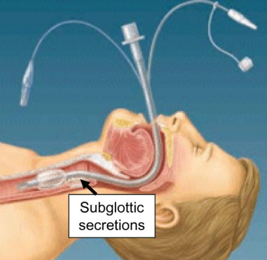 Subglottic suction (성문하 분비물 배액) : 네이버 블로그