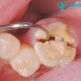 신경치료 후 치아파절