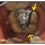 오래된 아말감을 그냥 두지 마세요 [아말감 후 치아파절]