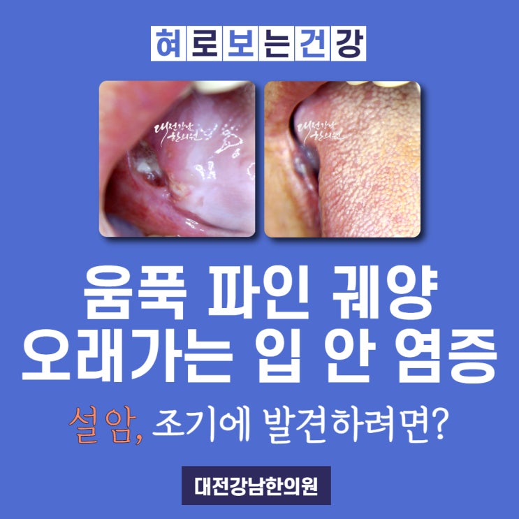 설암은 어디에 많이 생길까? 설암 사진으로 초기 증상 알아봐요 : 네이버 블로그