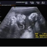 임신일기 30주 : 임신 초음파, 태어날 아기 몸무게 추측하기