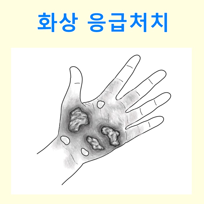 화상응급처치 1도 2도 3도 화상연고 및 치료 : 네이버 블로그