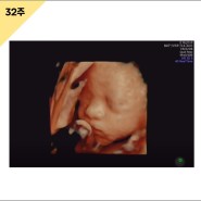 임신 32주 임산부 백일해주사 부산 인구보건복지협회