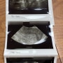 [첫 임신 준비]배란 1일째~배란 14일째 기록/임신 극초기 증상/화학적 유산