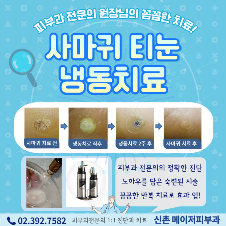 사마귀 냉동치료 티눈 냉동치료 가격 효과 비용 피부과 제거 신촌 이대 홍대 마포 공덕 아현 피부과전문의 [메이저피부과] : 네이버 블로그